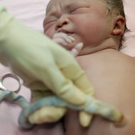 Umbilical Cord Care In Babies