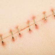 Postpartum Incision Pain