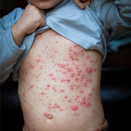 Fifth Disease In Toddlers