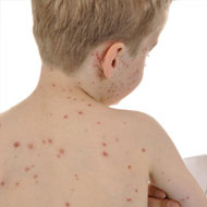 Chicken Pox In Toddlers