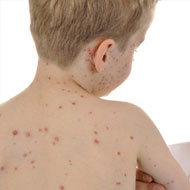 Toddler Chicken Pox