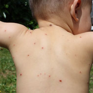 Psoriasis In Toddlers