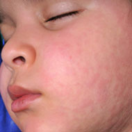 Toddler Skin Allergy