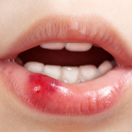 Canker Sores In Toddlers