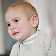 Measles In Toddlers